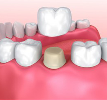 Dental Crowns in Saffron Walden