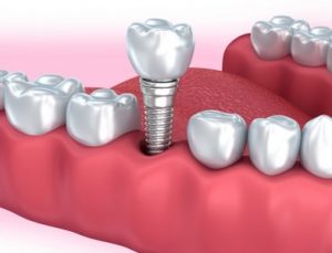 dental implants