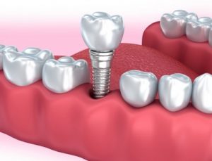 dental implants