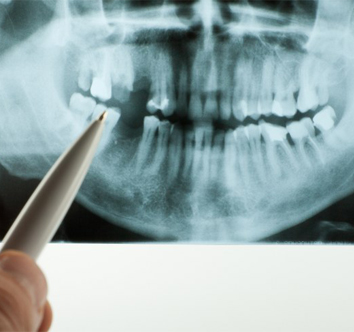 Wisdom Tooth Extraction in Saffron Walden